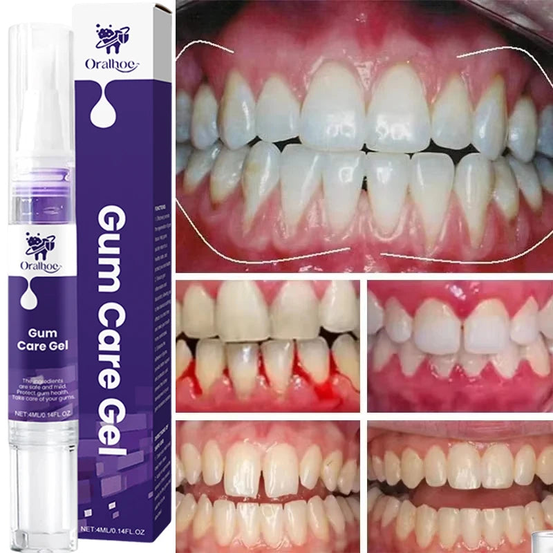Repair Damaged Gums Gel Serum Rapid Relieve Sore Tooth Allergy Dental Caries Tooth Cleaning Deep Cleaning Teeth Stain Toothpaste
