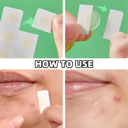 Hydrocolloid Acne Patch