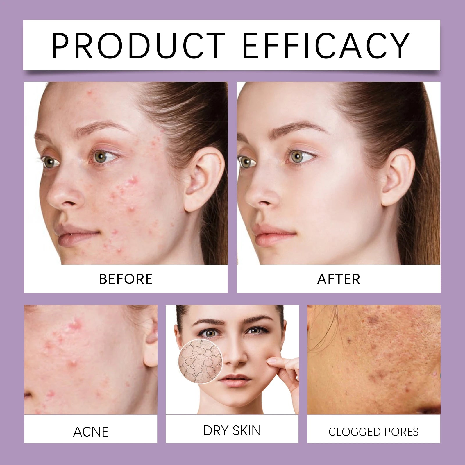 Berry Scented Blemish Lotion Care Facial Moisturizer Reduce Breakouts &amp; Tighten Skin Non-Comedogenic Hydrator Clear Glowing