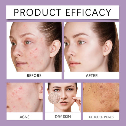 Berry Scented Blemish Lotion Care Facial Moisturizer Reduce Breakouts &amp; Tighten Skin Non-Comedogenic Hydrator Clear Glowing